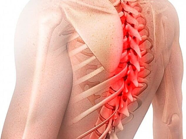 A osteocondrose da columna vertebral torácica é unha forma rara da enfermidade
