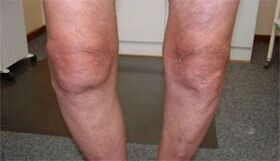 Síntomas da osteoartrite