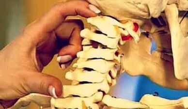 Razóns para o desenvolvemento da osteocondrose cervical