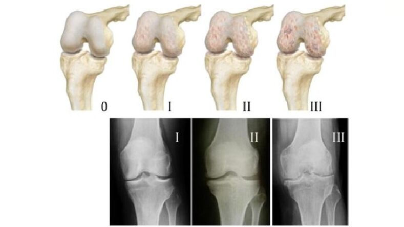 Etapas da artrose da articulación do xeonllo na radiografía