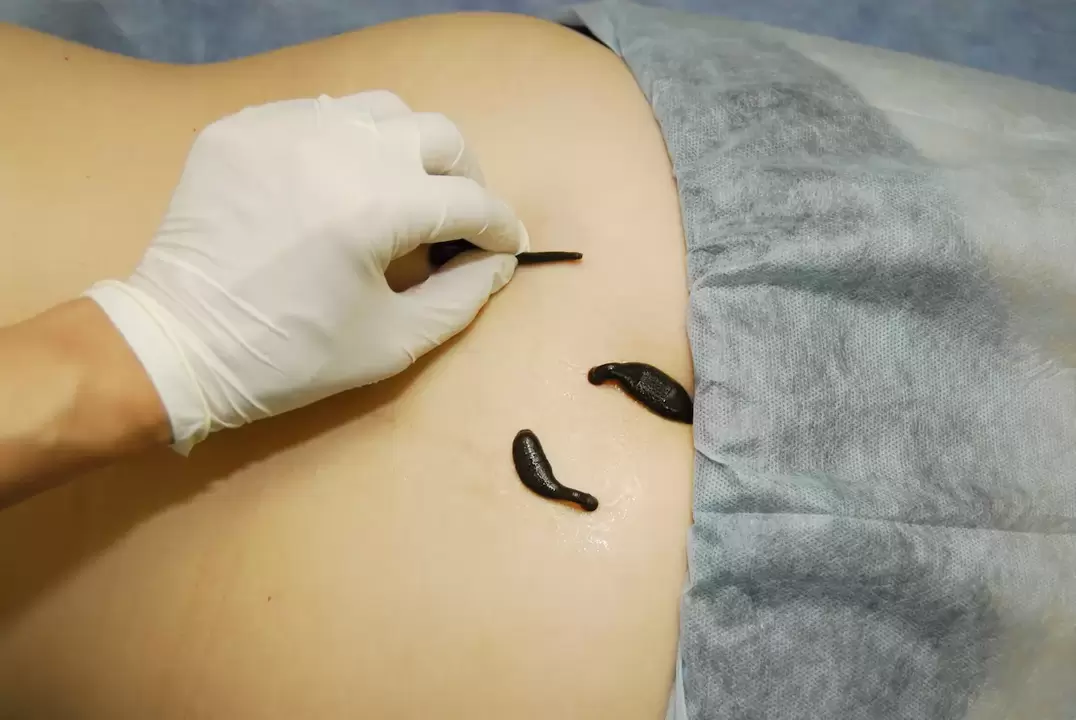 Colocación de sanguijuelas para osteocondrose lumbar