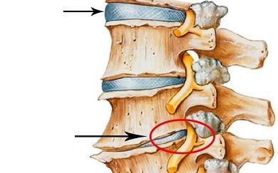 Etapas de desenvolvemento da osteocondrose cervical