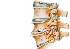 Causas da osteocondrose cervical