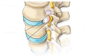 Principais síntomas da osteocondrose cervical