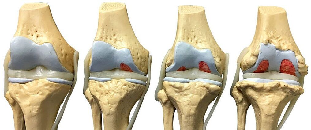 Graos de artrose da articulación do xeonllo